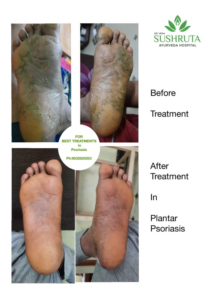 Plantar Psoriasis Before And After Sushruta Ayurveda Hospital